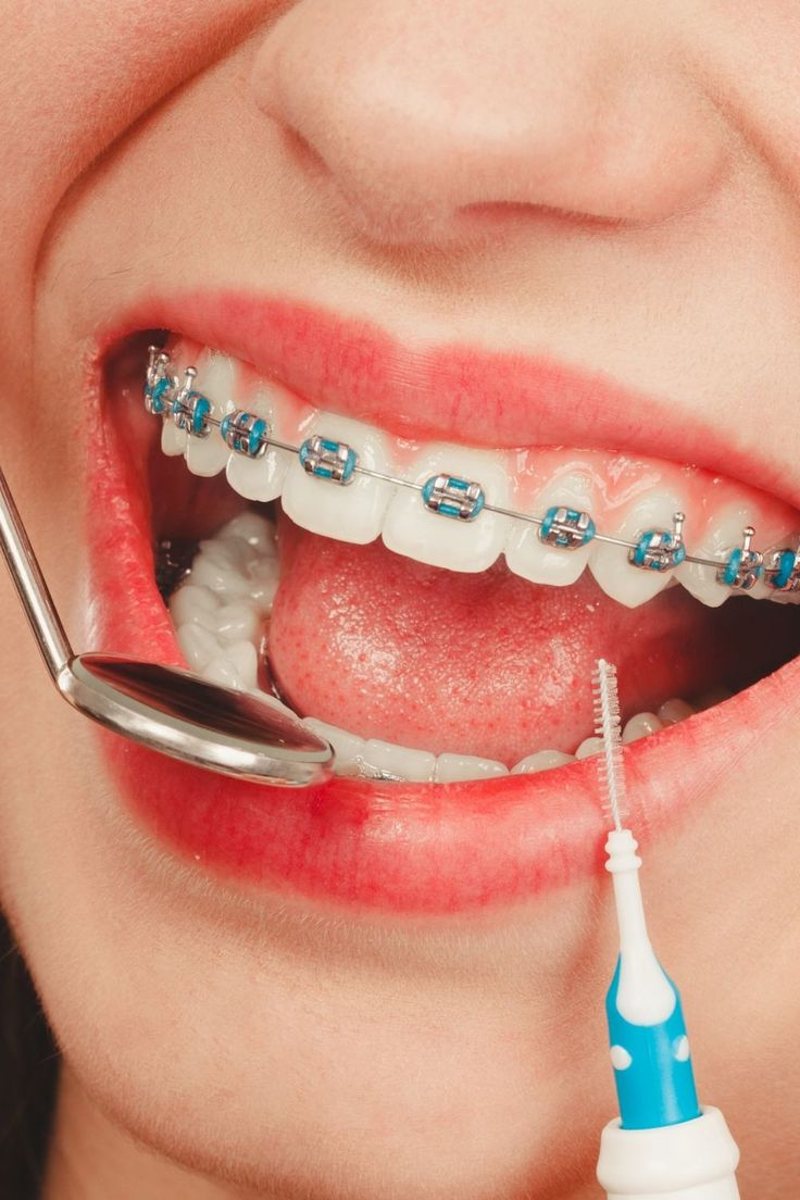Perawatan orthodonti untuk gigi rapi