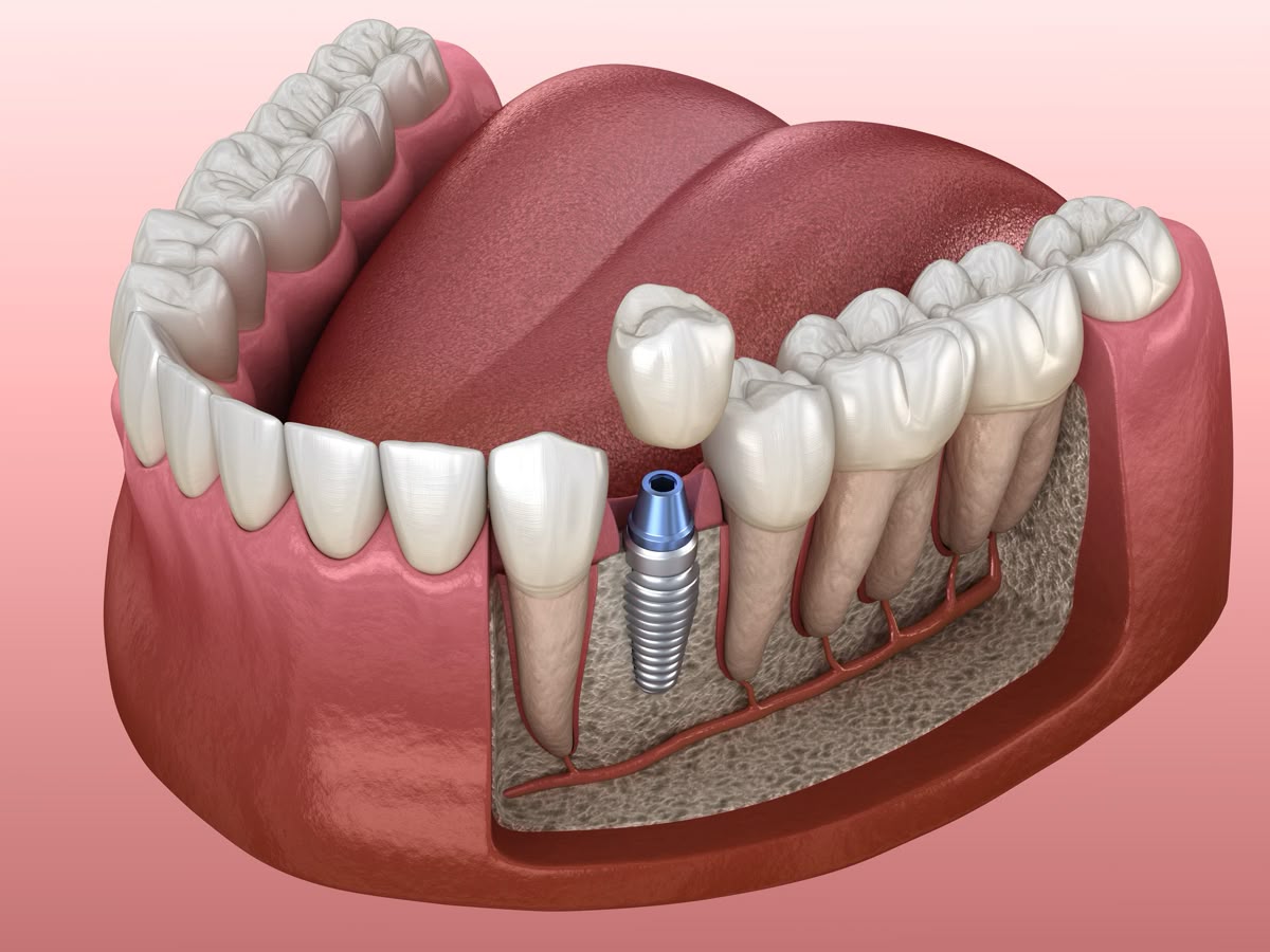 Perawatan implant gigi untuk pengganti gigi